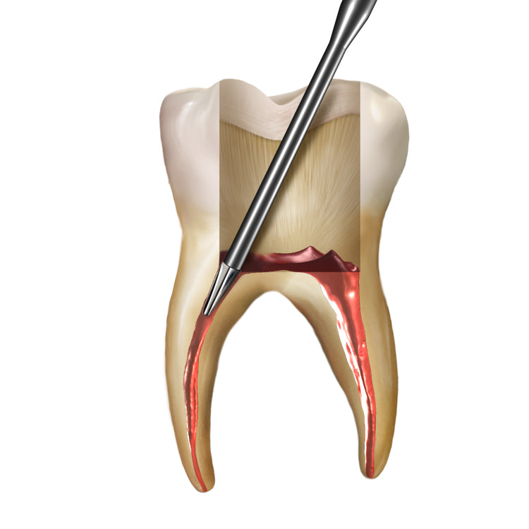 SS White Endoguide EG2 (5pk)