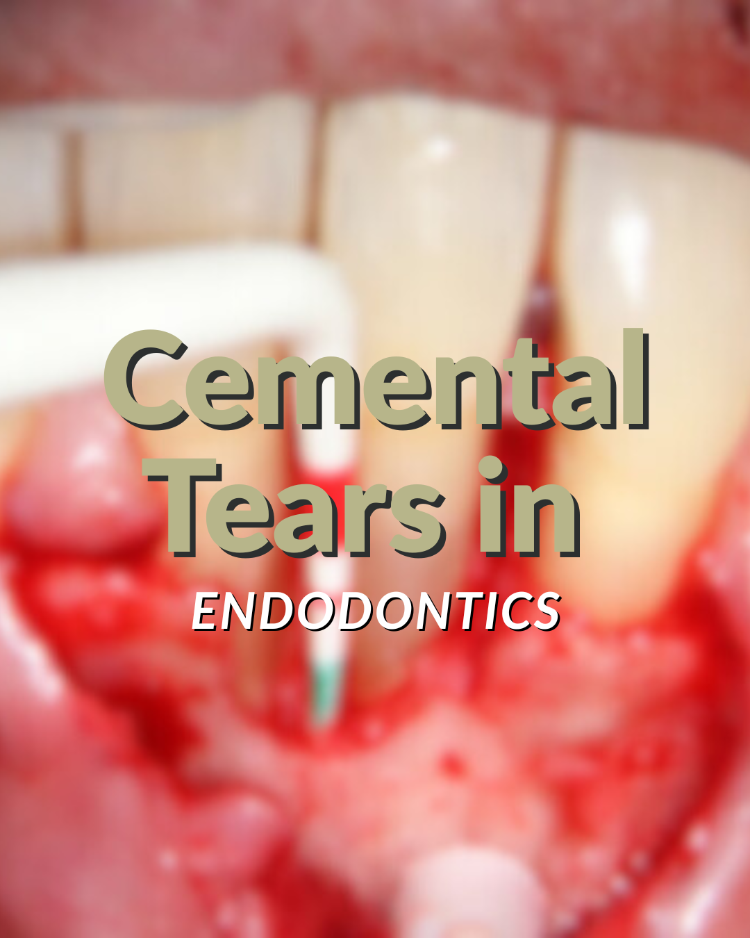 Cemental Tears in Endodontics
