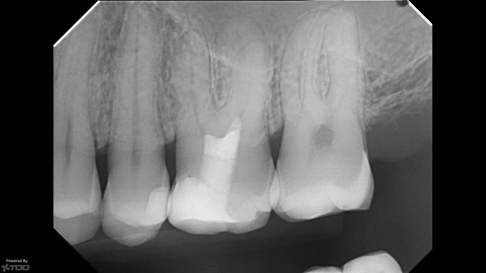 Bioclear Evolve Matrix Pulpotomy