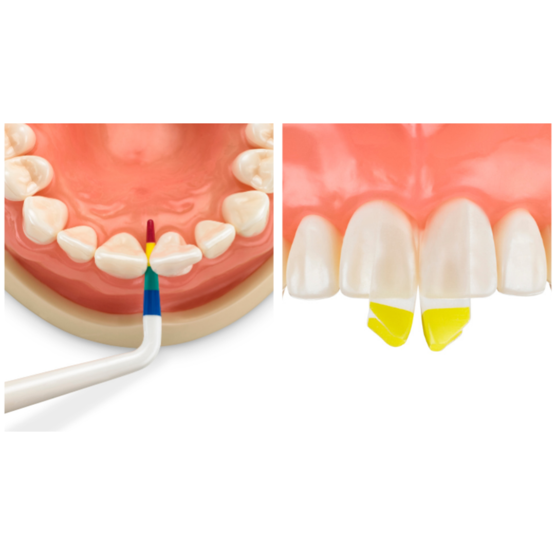 Bioclear Black Triangle/Anterior Composite Hands-on course - Sydney 13 June 2026