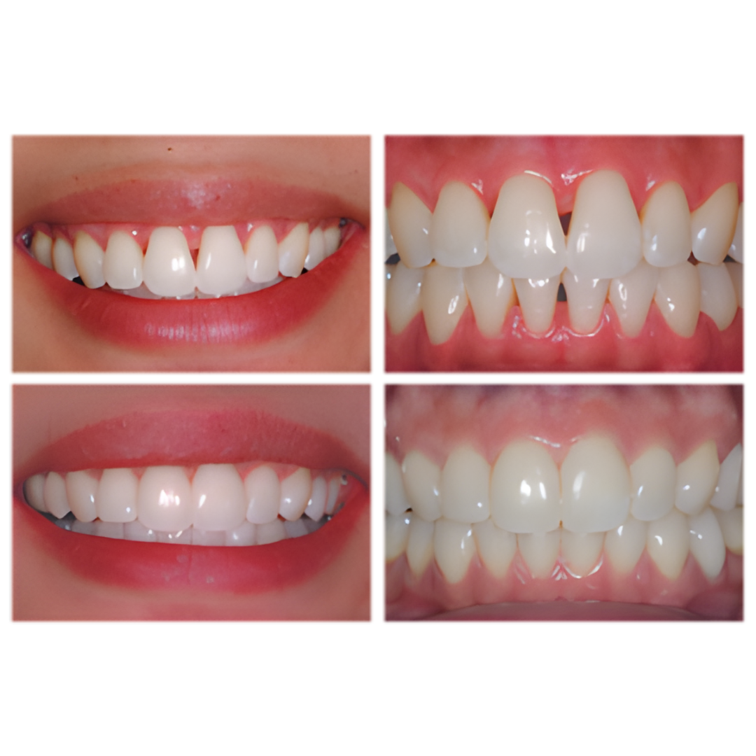 Bioclear Black Triangle/Anterior Composite Hands-on course - Sydney 13 June 2026