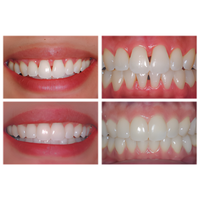 Bioclear Black Triangle/Anterior Composite Hands-on course - Sydney 13 June 2026