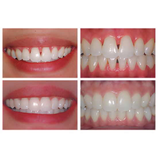 Bioclear Black Triangle/Anterior Composite Hands-on course - Melbourne 9 May 2026