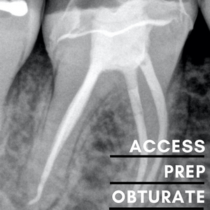 Endodontic Access Prep & Obturate - Sunshine Coast 13 Sep 2024