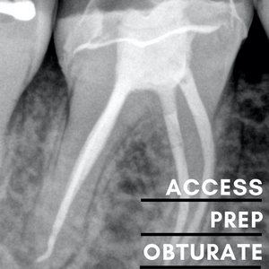 Endodontic Access, Prep & Obturate - Melbourne 14 February 24