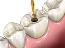 Endo Access Bur Set