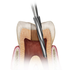 SS White Safe End Endodontic Access Bur(10pk)